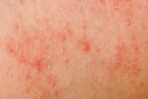 潘俊伸医师提醒,儿童身上起红疹千万别轻忽,小心感染「传染性红斑」.