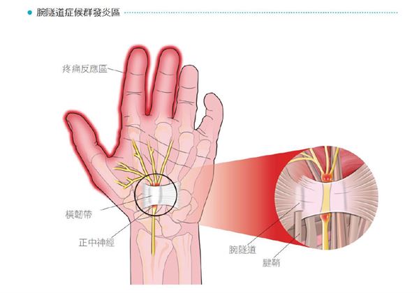 常见形成原因为手腕部位长期处於紧缩状态,造成手腕处的正中神经受到