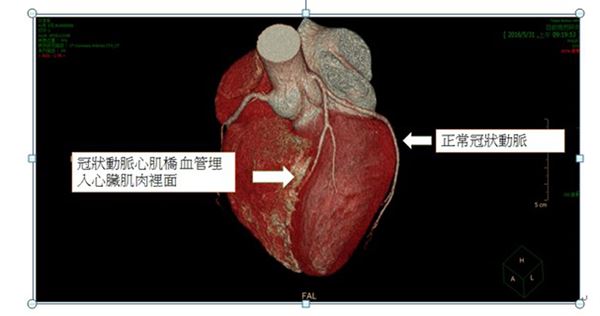 猝死警讯:胸闷又盗汗,心肌桥畸形惹祸