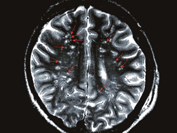 核磁共振检查下可发现脂肪粒沉积在男大生脑部,有如满天星.