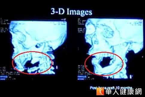 整体口腔重建 帮助口腔癌友恢复咀嚼