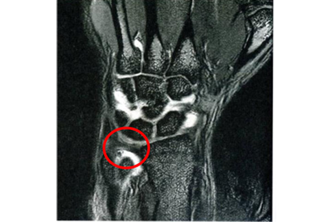 就以三角軟骨(tfcc)損傷為例,一旦損傷,可能影響到手腕功能,甚至造成