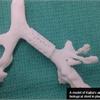 3D列印呼吸道　救活氣管缺陷嬰兒