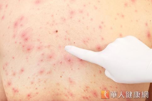 胸前冒青春痘 竟是黴菌毛囊炎惹禍 林書賢 一般皮膚病 皮膚科 健康新知 華人健康網