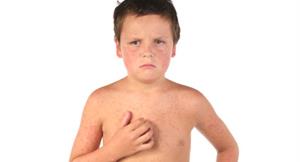 告別惱人的疹子　兒童常見夏季皮膚病