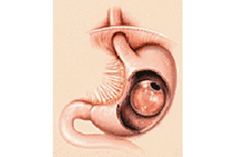 胃水球手術是在內視鏡的監視下，把1個矽膠材料的水球經由食道放進胃內，以達到有飽足感的減重效果。（圖片提供／北醫附設醫院）