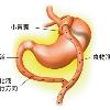 腹腔鏡胃繞道術成果豐　美視為黃金標準
