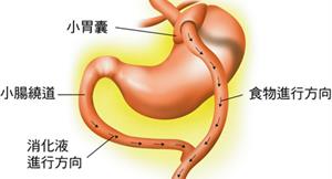 腹腔鏡胃繞道術成果豐　美視為黃金標準