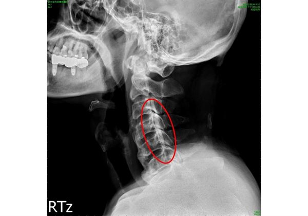 颈椎项韧带钙化图片ct图片