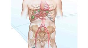 轉移性腸癌新契機！放射栓塞+化療