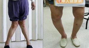 退化性關節炎腳變形　置換關節真給力