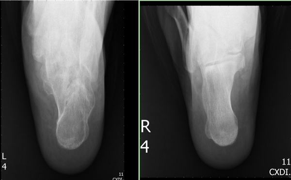 患者evelyn的左腳(左邊x光片)明顯與正常的右腳不同,出現變形現象.