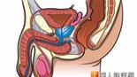 前列腺肥大治療新趨！雷射汽化術較安全