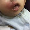 蚊子咬一口！男嬰嘴角竟罹蜂窩性組織炎