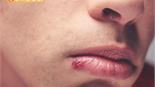 下嘴唇長「草莓」腫塊　原來是血管瘤在作怪