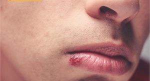 下嘴唇長「草莓」腫塊　原來是血管瘤在作怪