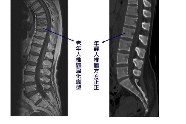 老年人腰椎与年轻人腰椎比较图(图片提供/大千医院)