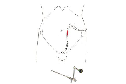 单一腹腔镜孔洞导管固定技术,将导管放置到最佳位置,于导管下以尼龙线