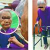 百歲人瑞臉長惡性腫瘤　游離皮瓣移植術解救