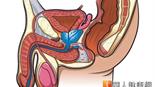 醫：若PSA持續升高　應做攝護腺切片