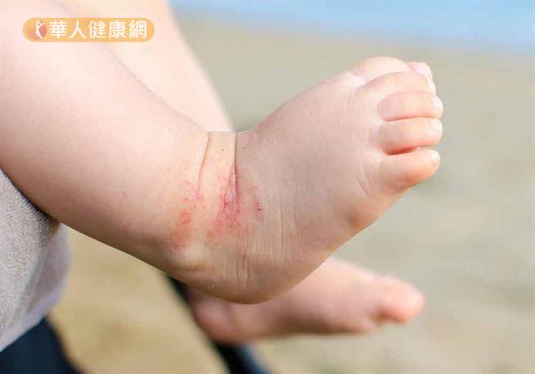 嬰兒的皮膚 是痱子 熱疹 汗疹 濕疹 還是異位性皮膚炎 小兒皮膚科 兒科 健康新知 華人健康網