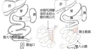 全靜脈營養引致命併發症　小腸移植救命