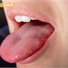 舌頭莫名疼痛　小心女性口腔燒灼症候群