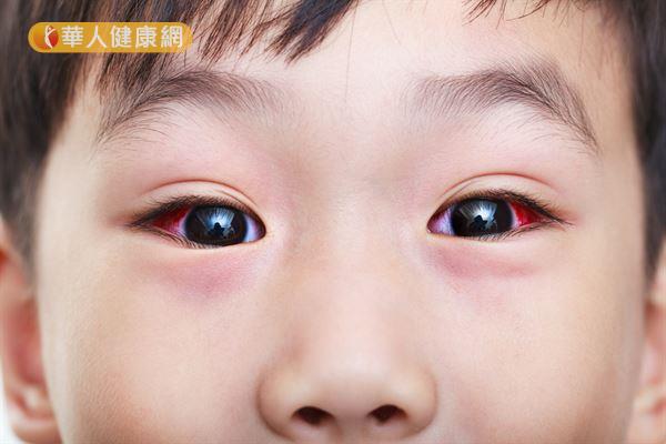 婴儿眼白有红血丝图片图片
