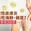 異位性皮膚炎不能吃海鮮、雞蛋?破解常見3迷思