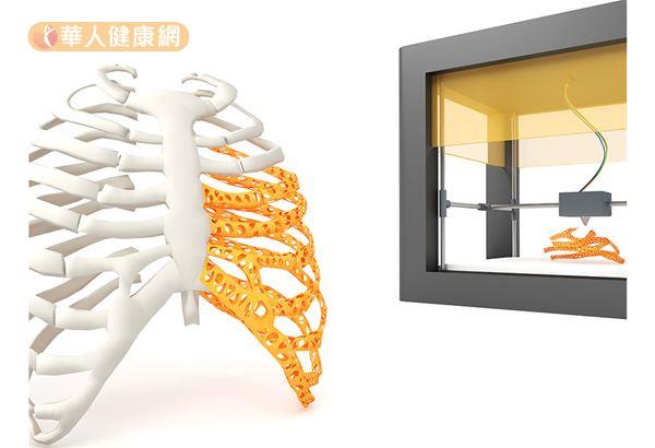 肋骨骨折 呼吸都會痛 3d列印輔助新突破 華人健康網