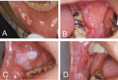 (a)发生於右下唇黏膜之复发性口腔溃疡病变