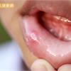 口腔內有白白物體，小心是口腔黏膜疾病上身