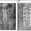 脊椎變形如樓塌　透視導航提升安全性