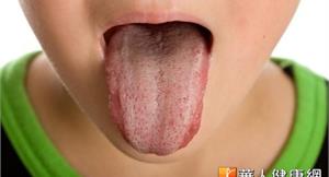 舌破舌裂　中醫：多因熱症而起