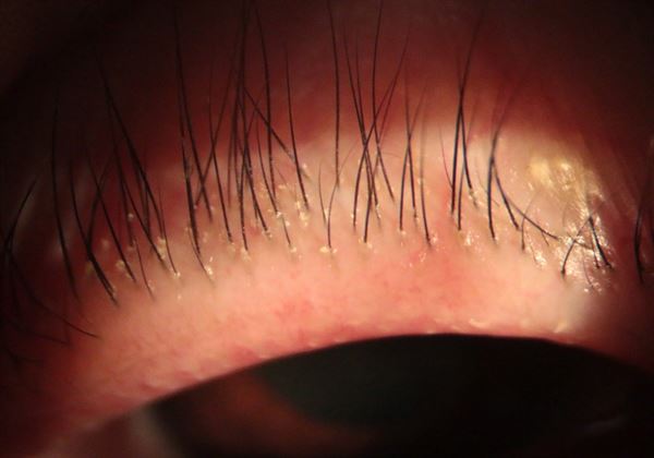 毛囊蠕形螨虫属于寄生虫,不是细菌或病毒,若不治疗可能造成毛囊发炎