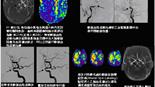 中風黃金治療！動脈血栓溶解延至6小時    