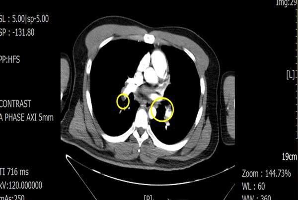 該案例經電腦斷層檢查，顯示肺動脈血管有明顯阻塞情形，正常情況下黃圈處應該呈現白色通透之顯影。