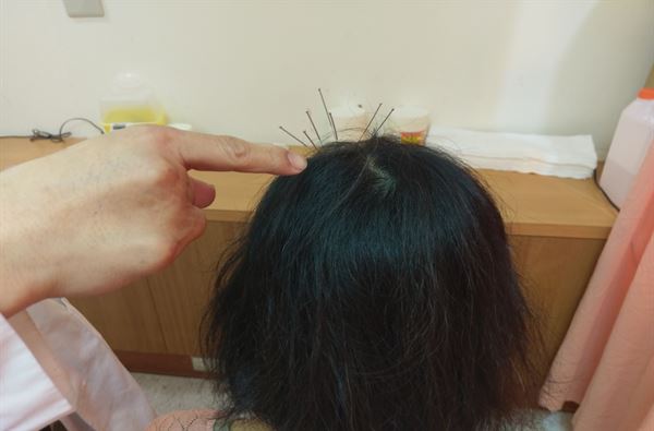5旬婦壓力太大「鬼剃頭」!中醫針灸刺激頭皮穴位，明顯改善 | 華人健康網