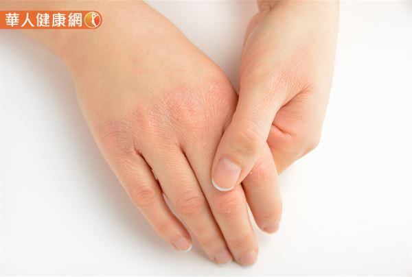 手足症候群一旦發生，除了會使患者手、腳等患部出現熱、痛感、紅斑性腫脹；嚴重時，甚至可能伴隨有脫屑、潰瘍和劇烈疼痛等症狀發生，常對患者生活品質帶來顯著的負面影響。