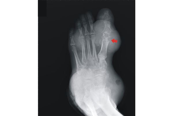 （圖一）發生在腳踝與第一大腳趾的痛風石，在X光下可以看到明顯的軟組織腫脹，造成大腳趾附近的骨頭破壞(紅色箭頭處)。（圖片／吳建陞主任提供）
