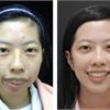 20妙齡女飽受暴牙、顏面歪斜苦惱　顳顎關節整合治療找回自信
