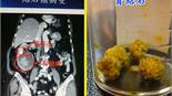 結石久放腎臟　不痛也會引發癌變