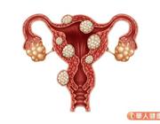 《子宮肌瘤》缺乏維他命D可能影響子宮肌瘤？