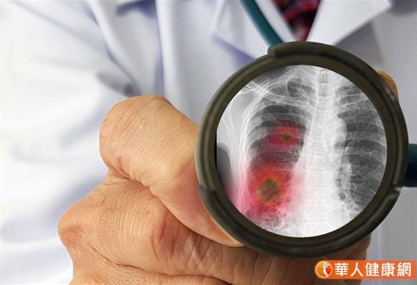 《刺胳針》刊登：武漢肺炎患者肺部放射狀玻璃樣混濁變化　醫：流感重症也可能發生