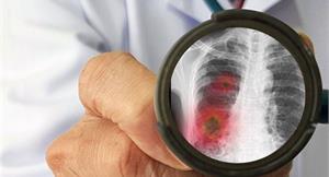 《刺胳針》刊登：武漢肺炎患者肺部放射狀玻璃樣混濁變化　醫：流感重症也可能發生