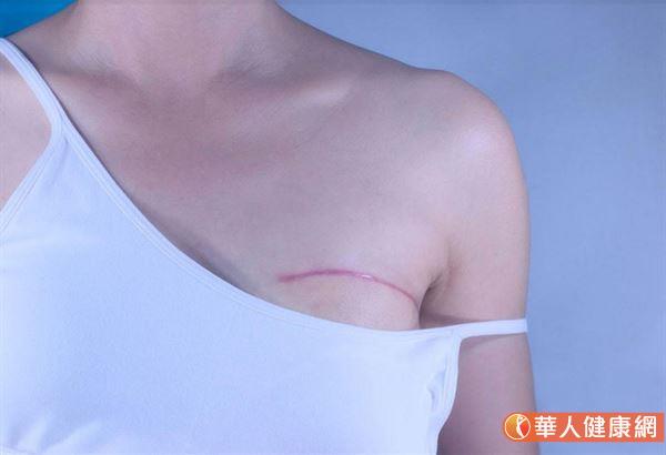 乳房缩小手术疤痕图片图片
