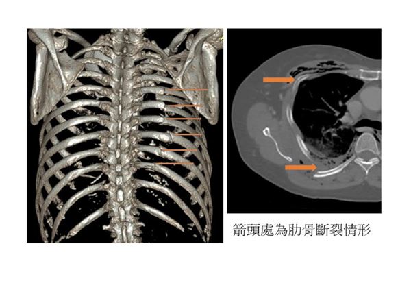 她跌一跤斷了12根肋骨 引發連枷胸 靠 鈦 撐起肋骨 防止肺臟損傷 華人健康網