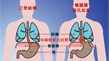 仁波切因橫膈膜裂孔疝氣，飽受胃食道逆流困擾逾50年　三術式手術解除煩惱