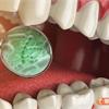 不只引起牙周病！研究發現：口腔內的「具核梭桿菌」細菌竟和大腸癌有關