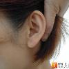 耳洞傷口招菌　導致感染性心內膜炎